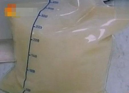 ������ţ�̻򶹽�֮�������Ʒ״��ѪҺ