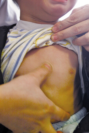 点按膻中穴。 点按膻中穴。