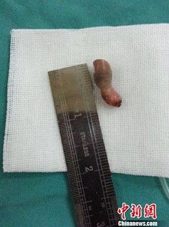 被切除的多余“舌头”。 钟宇 摄 被切除的多余“舌头”。 钟宇 摄