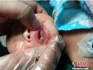 新生女婴多长了一个“舌头”。 钟宇 摄 新生女婴多长了一个“舌头”。 钟宇 摄