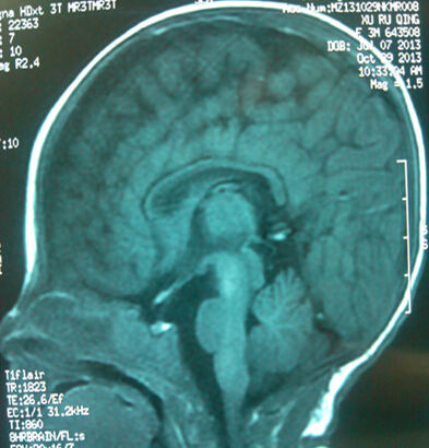 ˵MRI 