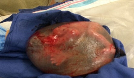 宝宝裹“水球”出生 (图片来自网络) 宝宝裹“水球”出生 (图片来自网络)