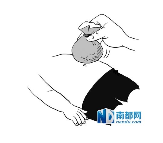 用艾包按摩肚脐止泻。 用艾包按摩肚脐止泻。