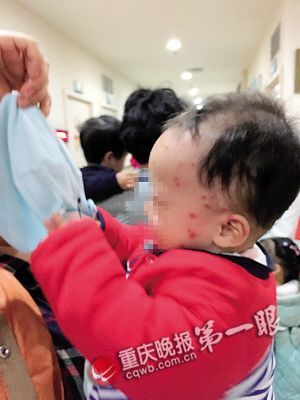 佳佳被螨虫搞得满头包 佳佳被螨虫搞得满头包