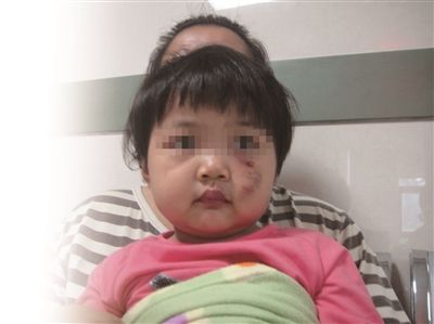 孩被狗咬缝20针 亲近还是远离宠物? 孩被狗咬缝20针 亲近还是远离宠物?