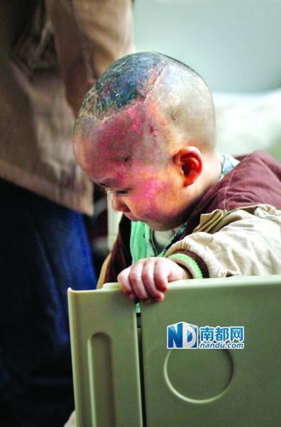 1月8日下午,小宝头上和脸上都是伤痕。 1月8日下午,小宝头上和脸上都是伤痕。