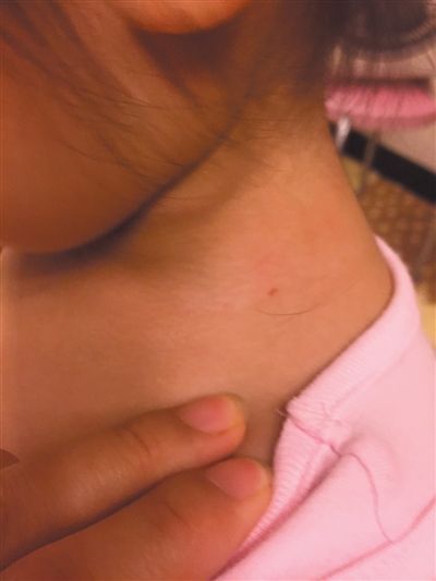 宫女士称,女儿珍珍(化名)脖子左侧有一个红色的小眼(红圈处),疑似针眼。宫女士供图 宫女士称,女儿珍珍(化名)脖子左侧有一个红色的小眼(红圈处),疑似针眼。宫女士供图
