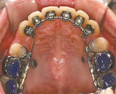 图是一例患者戴着隐形矫治器的口内照片。 图是一例患者戴着隐形矫治器的口内照片。